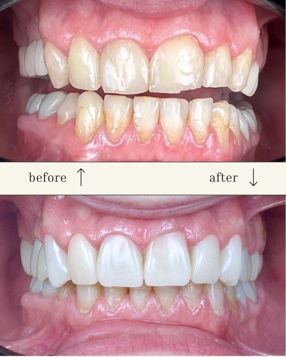 Comparație înainte și după tratament dentar